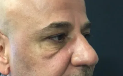 EH Before Male Lower Blepharoplasty