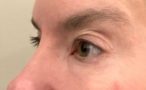 KY Before Upper Blepharoplasty Three Quarters