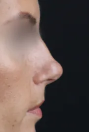 TJ Before Rhinoplasty
