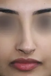 TJ Before Rhinoplasty Front
