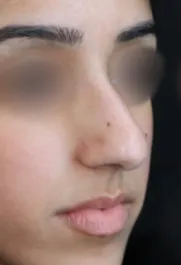 TJ Before Septorhinoplasty Three Quater View