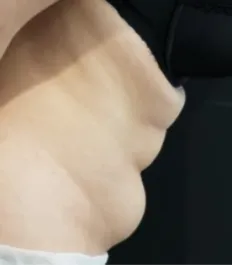 HS Abdomen Liposuction Before 2 Side Bent