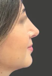 AN Septorhinoplasty After Side