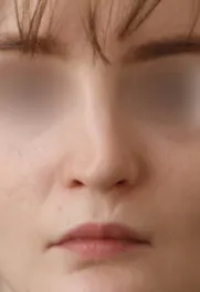 TJ Before Septorhinoplasty Front