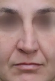 TJ Before Septorhinoplasty Front