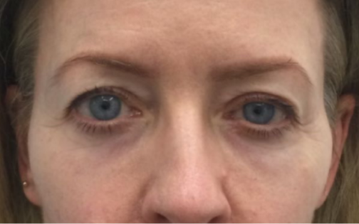EH Before Upper Blepharoplasty