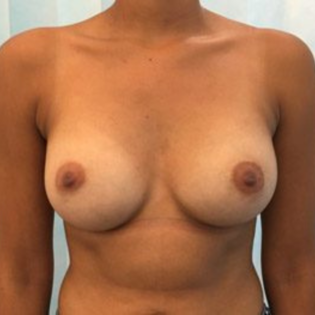GG Breast Augmentation After