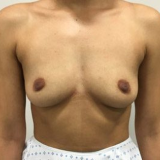 GG Breast Augmentation Before