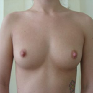 Cadogan Clinic GG Breast Augmentation Before