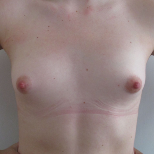 Cadogan Clinic WS Breast Augmentation Before