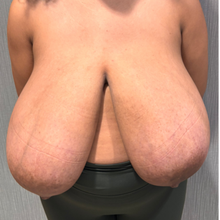 SSJ Breast Reduction Before Front