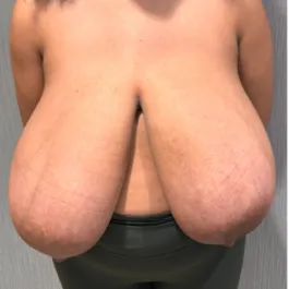 SSJ Breast Reduction Before Front