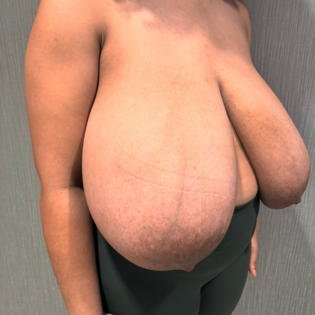 SSJ Breast Reduction Before Three Quarters