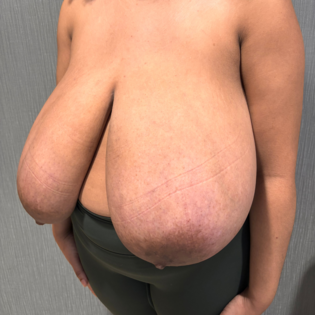 SSJ Breast Reduction Before Three Quarter Right