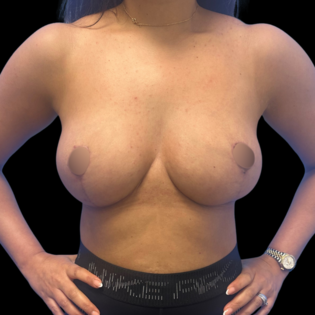 WS Breast Reduction After
