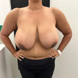 WS Breast Reduction Before