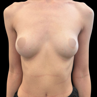 RK Breast Augmentation Before