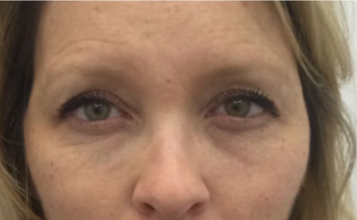 Unknown Before Upper Blepharoplasty Front
