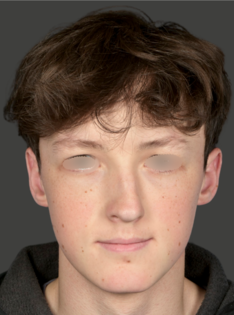 AN Rhinoplasty Before
