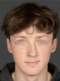 AN Rhinoplasty Before