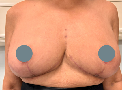SSJ Mastopexy After