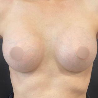 WS Breast Augmentation After