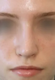 TJ After Septorhinoplasty Front