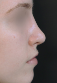 TJ After Septorhinoplasty