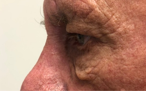 GG Before Male Lower Blepharoplasty