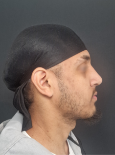 AN Rhinoplasty After