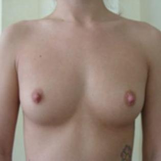 Breast Augmentation with Implants Before 3