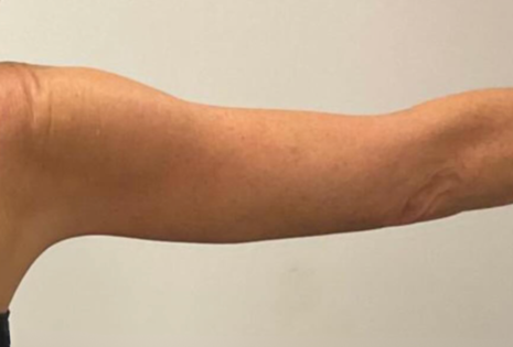 Cadogan Clinic Arm Lift PT After