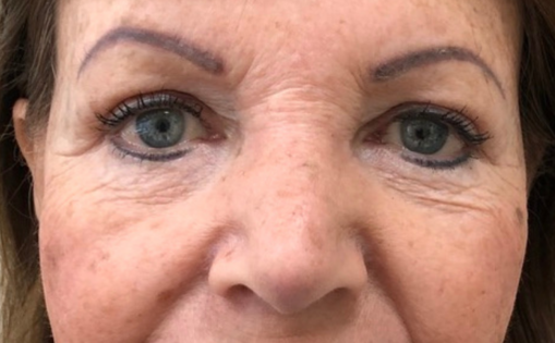 GG After Upper and Lower Blepharoplasty