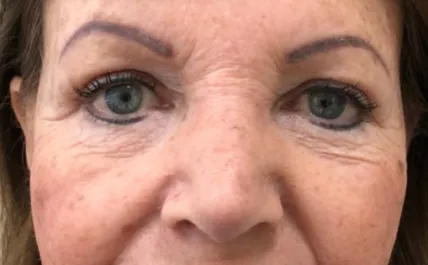 GG After Upper and Lower Blepharoplasty