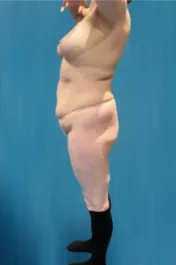 OT Abdomen Liposuction Before 1 Side