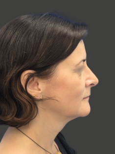 AN Rhinoplasty After