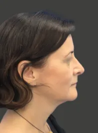 AN Rhinoplasty After