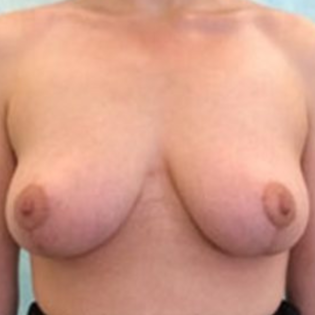 Breast Lift GG After
