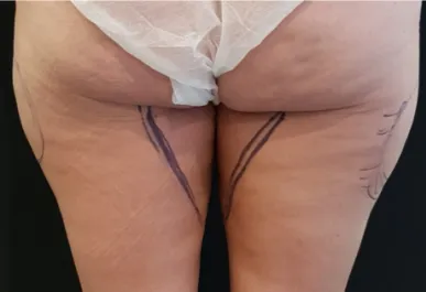 HS Inner Thigh Liposuction 1 Before Back