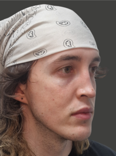 AN Rhinoplasty Before