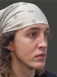 AN Rhinoplasty Before