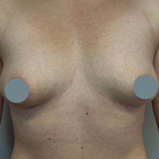 Cadogan Clinic SSJ Breast Augmentation Before
