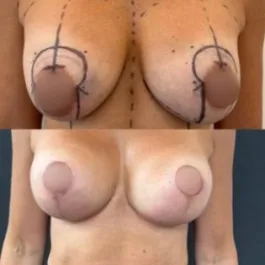 Mastopexy with implant exchange before and after