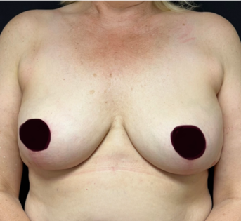 GG After Mastopexy Front