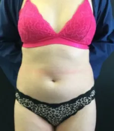 HS Abdomen Liposuction Before 1 Front