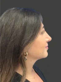 AN Rhinoplasty After