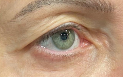 RR Before Upper Blepharoplasty