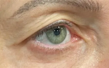 RR Before Upper Blepharoplasty