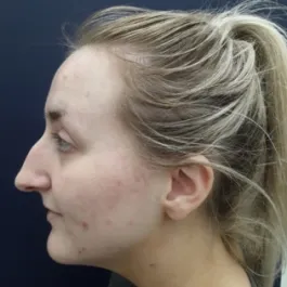 Unknown Before Rhinoplasty