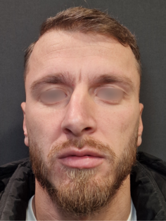 AN Rhinoplasty Before